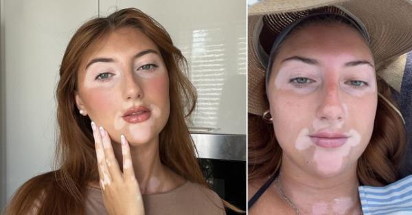 'People think my skin co<em></em>ndition is dodgy fake tan'