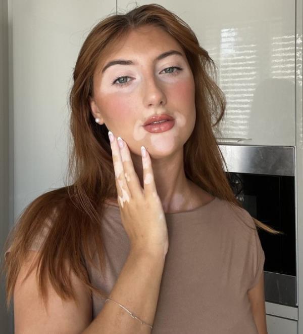 Eva said her skin co<em></em>ndition is often mistaken for bad fake tan