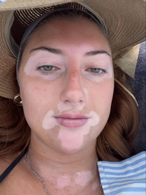Eva has the same co<em></em>ndition as Winnie Harlow