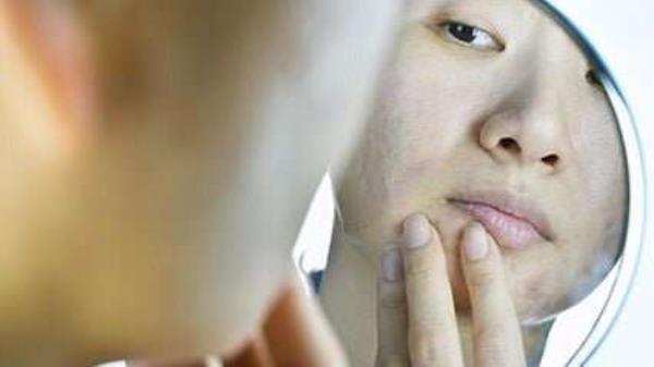 2004 to 2019 saw increase in isotretinoin use in girls, women